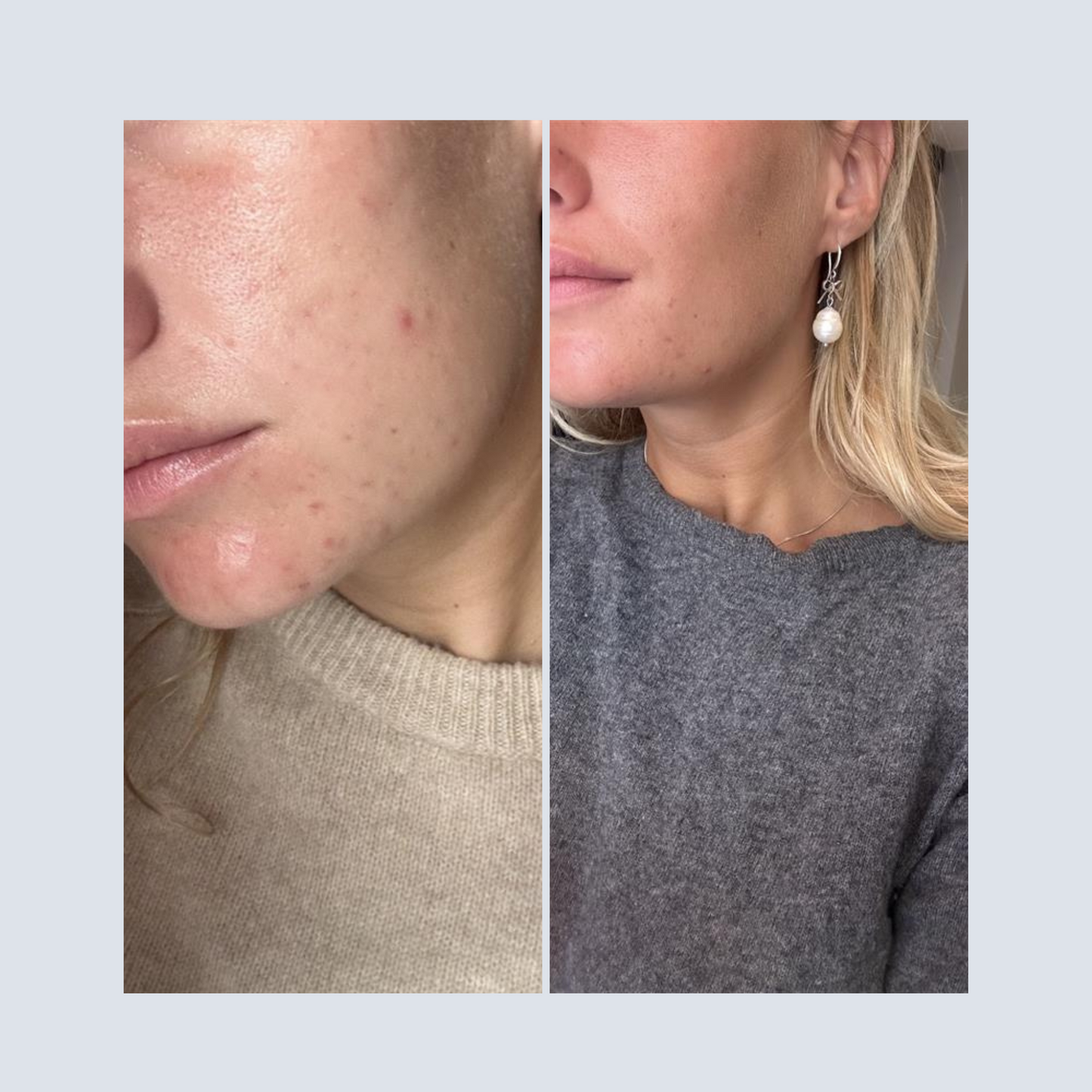 BIOpH Acne prone active solution 50 ml