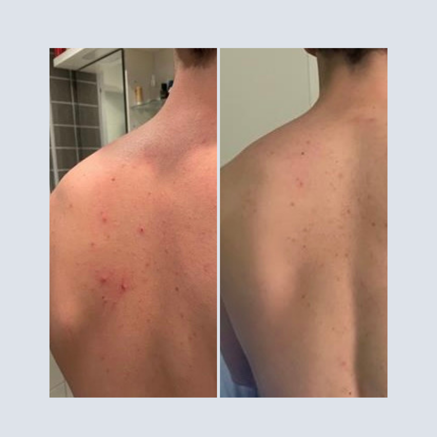 BIOpH Acne prone active solution 50 ml